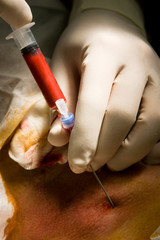 Central Vein Puncture for Catheter Insertion.