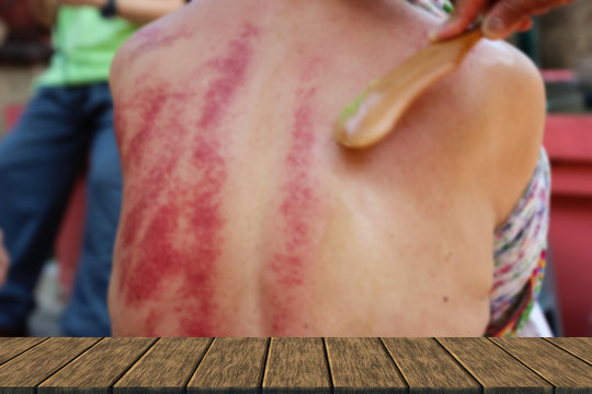 people demonstrate guasa method which is the Alternative medicin
