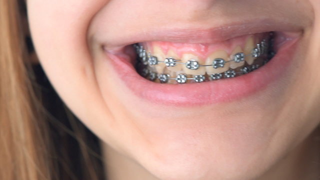 Beautiful smiling girl with retainer for teeth  .