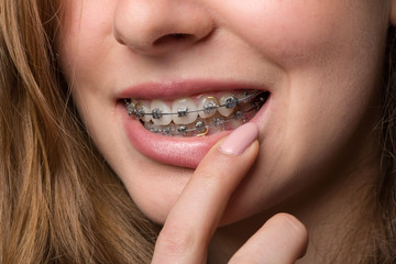 Mund einer jungen Frau mit Zahnklammer