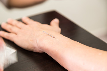 Focus on acupuncturist needle pricking into skin, with shallow depth of field