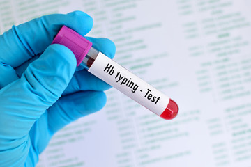 Obraz premium Blood sample for hemoglobin (Hb) typing test, thalassemia diagnosis 