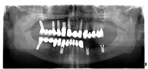 Dental x-ray with periodontitis problems