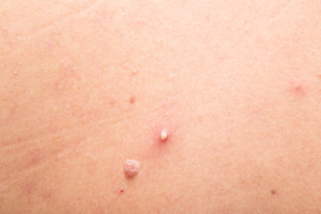 Fototapeta premium mole and pimple