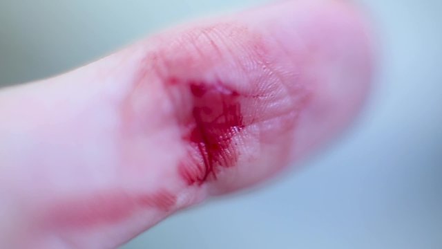 A wound on a finger and blood macro.