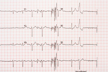Extrasystole On 12 Lead Electrocardiogram Record Paper