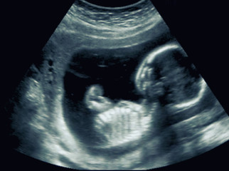An ultrasound of a human fetus during the 16th week