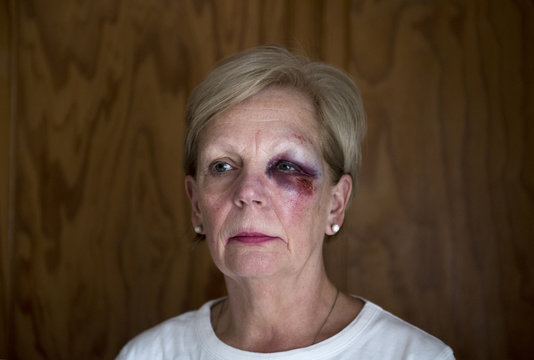 Portrait image of a mature woman with a bruised eye, with copy space.