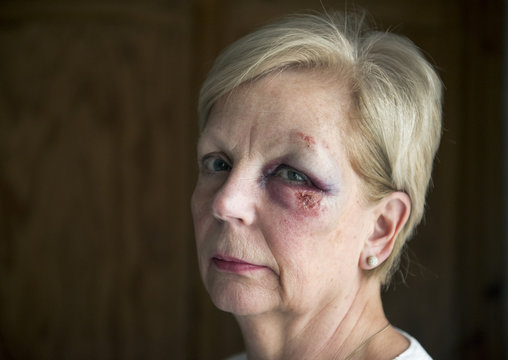 Portrait image of a mature woman with a bruised eye, with copy space.