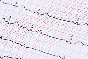 Sinus Heart Rhythm On Electrocardiogram Record Paper Showing Normal P Wave, PR and QT Interval and QRS Complex