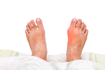 Man with right foot swollen and painful gout inflammation resting on bed