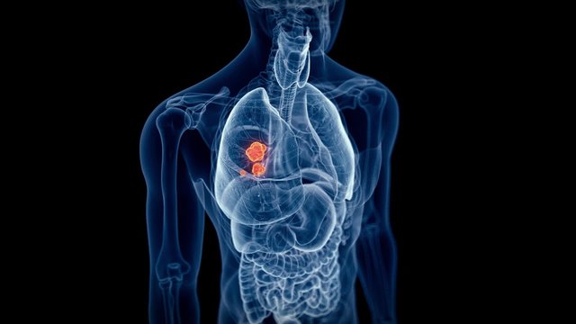 medical 3d animation of the lung cancer 