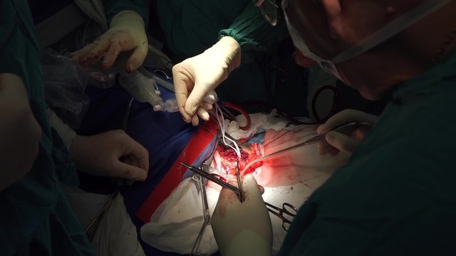 Rare surgery on trachea