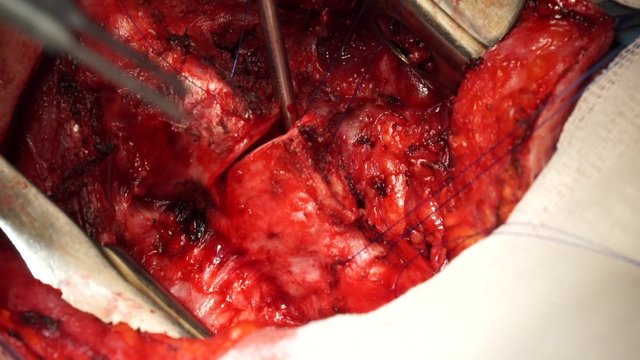 Rare surgery on trachea