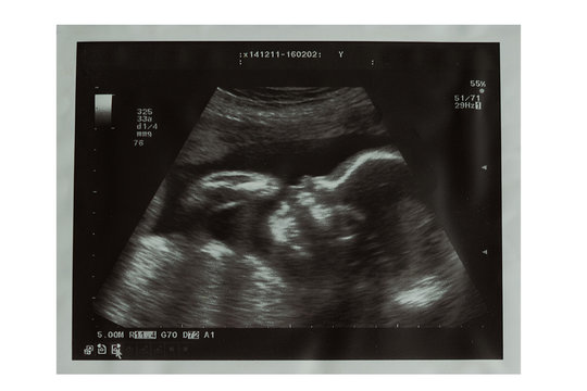Ultrasound picture of baby