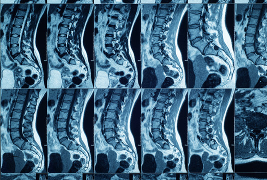 Magnetic resonance imaging of human spine