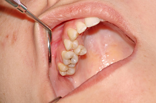 Crowding of the teeth of the upper jaw and caries of the upper m