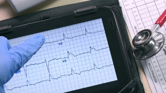Medicine. Examining an electrocardiogram (EKG or ECG) graph on a digital computer tablet to check for problems with the electrical activity of the heart.