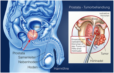 Problemă cronică de erecție a prostatitei