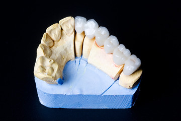 Fototapeta na wymiar Prótesis fija dental 