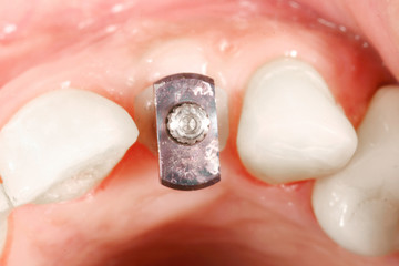 Dental surjery implant view
