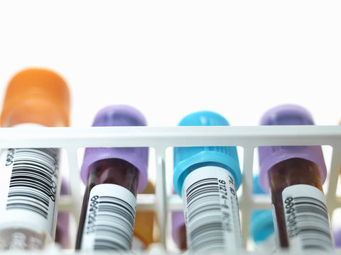 A row of human blood and chemistry samples awaiting testing in the lab