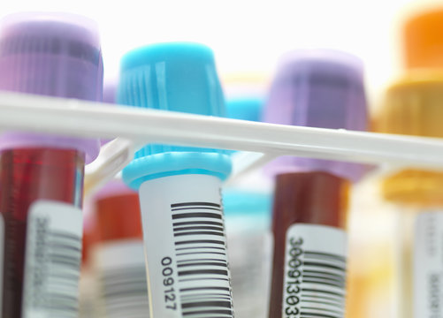 A row of human blood and chemistry samples awaiting testing in the lab