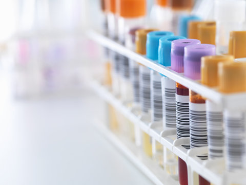 A row of human samples for analytical testing including blood, urine, chemistry, proteins,anticoagulants and HIV in lab