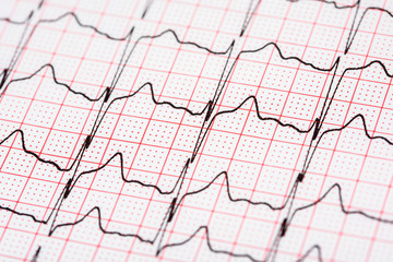 Extrasystoles On Electrocardiogram Record Paper