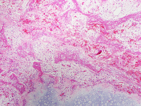 H&E stain, light microscopy, healing fracture callus with exuberant cartilage and new bone formation