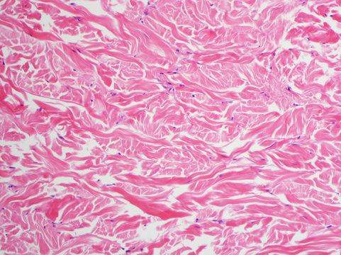 H&E stain, light microscopy, abundant collagen in a Gardner fibroma