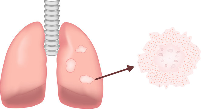 Granulomatous Lung Disease