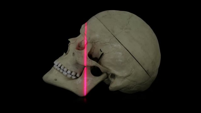 Laser line three dimensional scan of human skull model