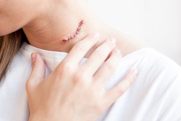 Scar mole on neck