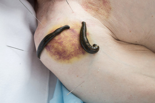 Treatment of medical leeches people and acupuncture.