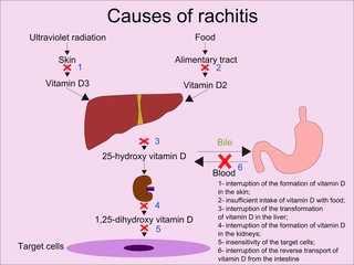 The most common causes of rachitis  