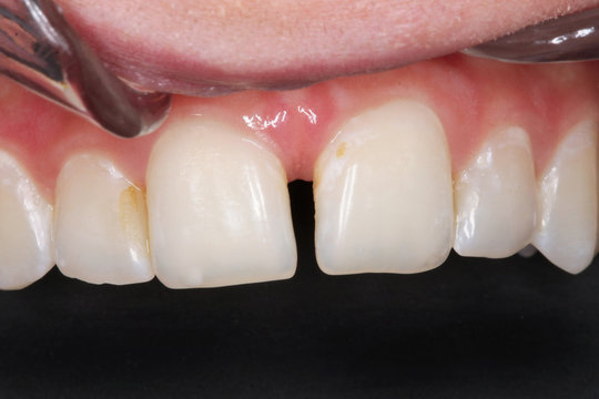 Gebiss Frontz&auml;hne Zahnl&uuml;cke Zahnheilkunde 