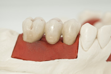 Metal free ceramic dental crowns