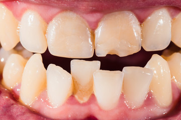 A close-up of male's mouth with crooked broken teeth and odontolith