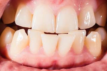 Close-up of a female mouth with crooked teeth and malocclusion