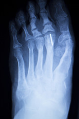 Foot toes metal implant xray scan