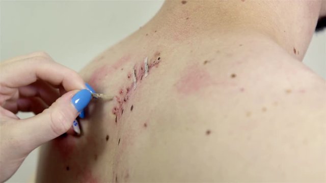 Removing thin stitches from surgical wound