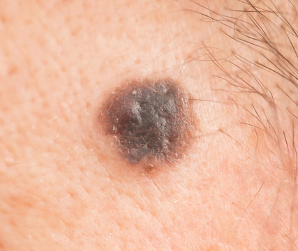 black mole on the skin