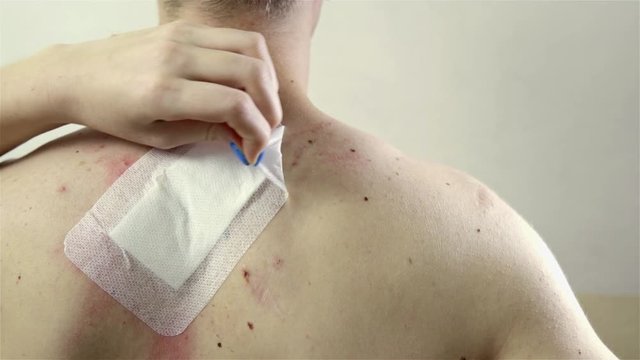 Removing bandages of big wound on person back