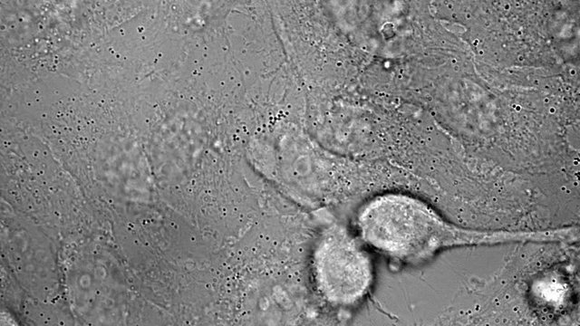 Movement, division and death of HeLa cervical cancer cells under microscope
