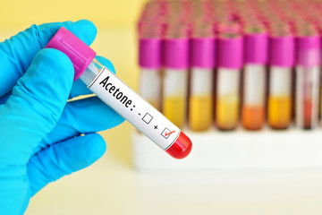 Naklejka premium Blood sample positive with acetone chemical testing 