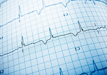 Electrocardiogram