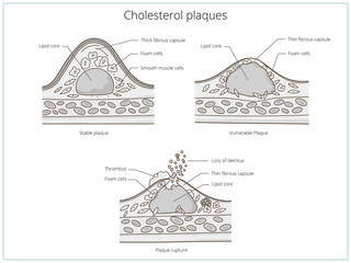 Cholesterol plaque medical educational vector