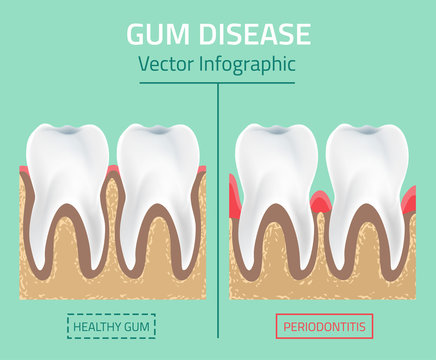 Teeth Infographic Gum Disease Stages