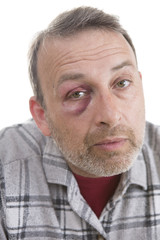 Middle-aged Caucasian male Emotional Portrait with a Real Bruise